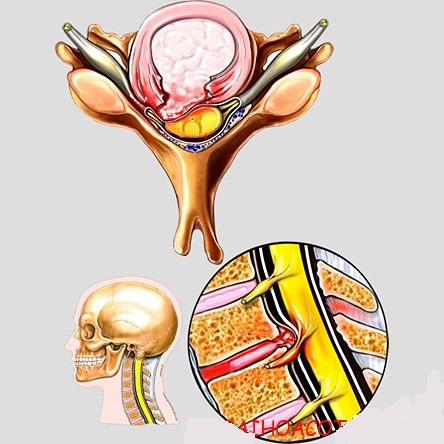 Chèn ép tủy - Hình ảnh minh họa